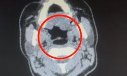 Uluslararası u*uşturucu madde ticareti yapan şüpheli midesinde u*uşturucuyla yakalandı