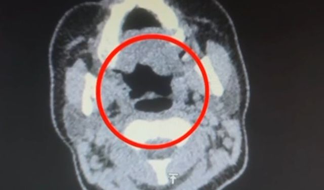 Uluslararası u*uşturucu madde ticareti yapan şüpheli midesinde u*uşturucuyla yakalandı