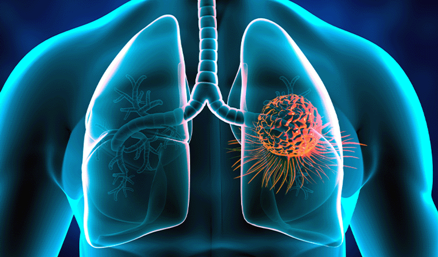 Akciğer kanserinde nodülün boyutu çok önemli